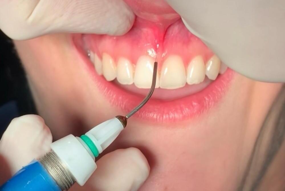 Chirurgia laser bocca con strumento laser in operazione